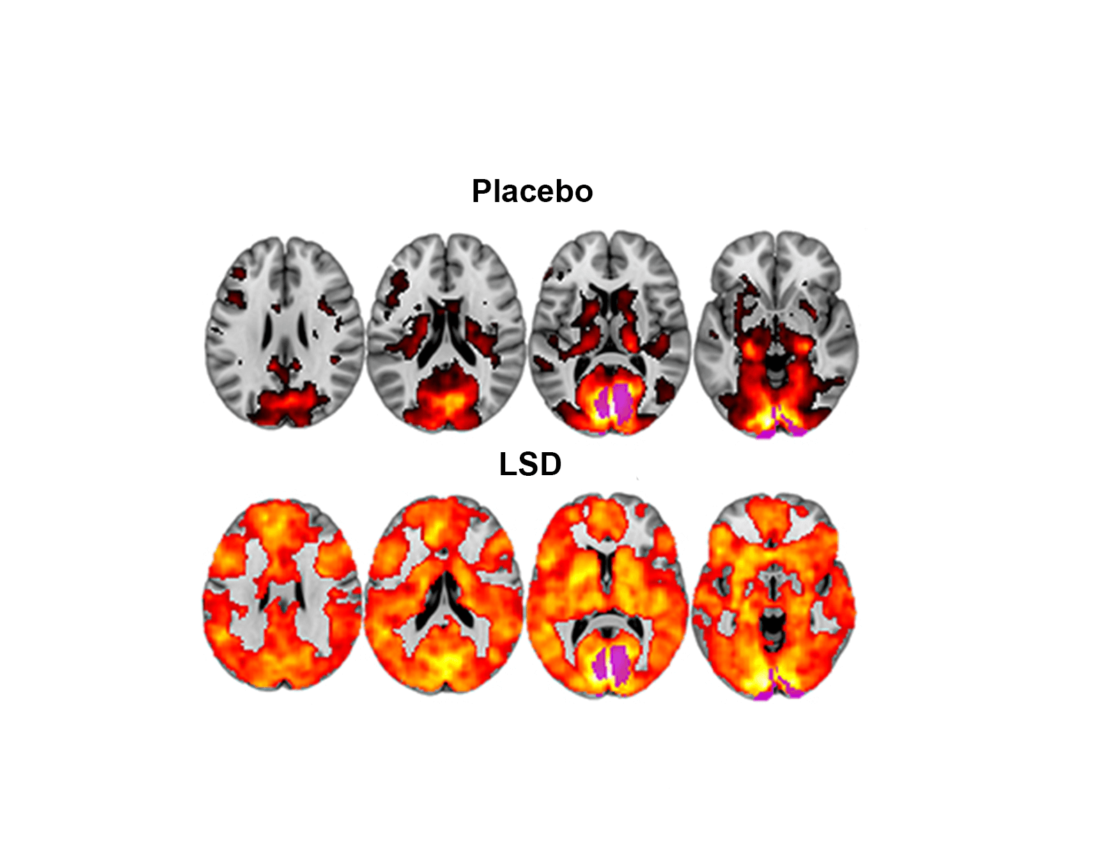 Psychedelics And The Default Mode Network Dmn Mdma Therapy Netherlands